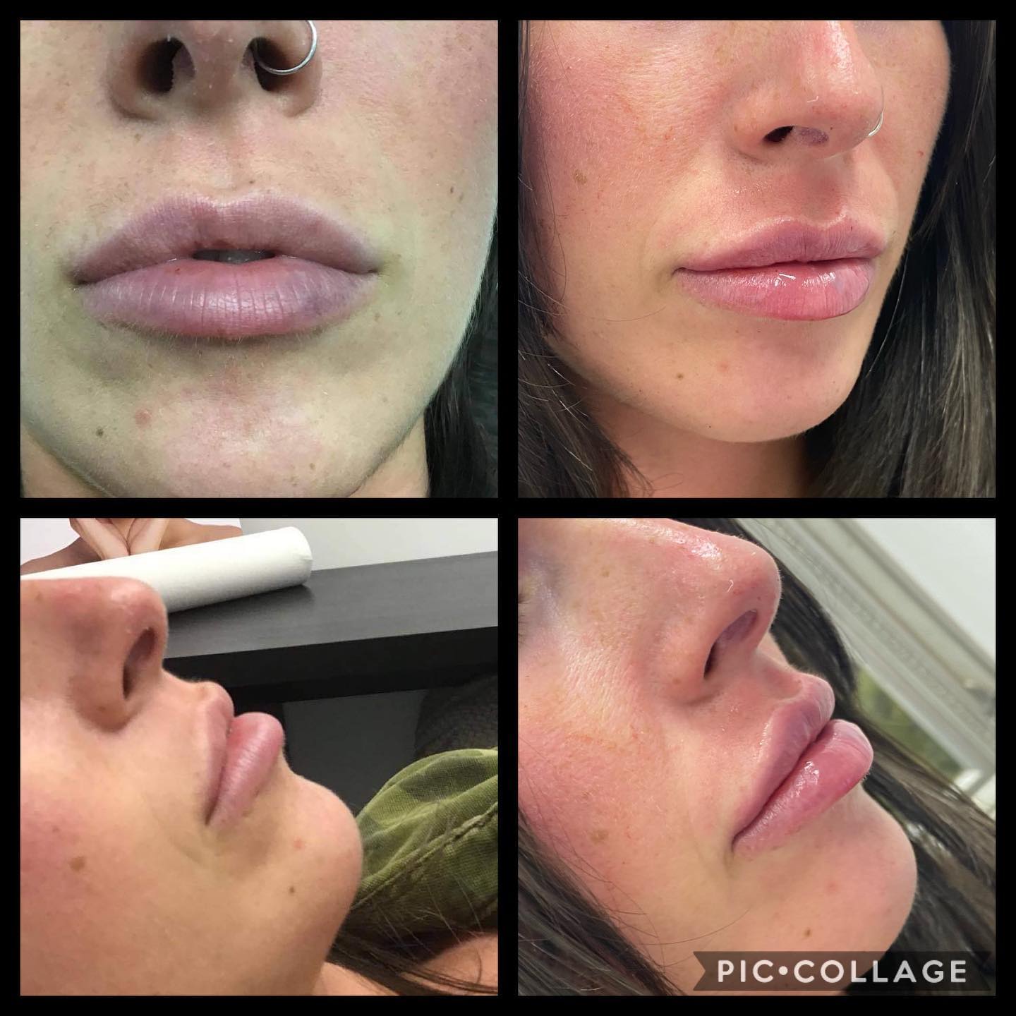 Proderma - 🔥Before and After . 🔥1 ml Premium filler . 🔥The lips has to ...