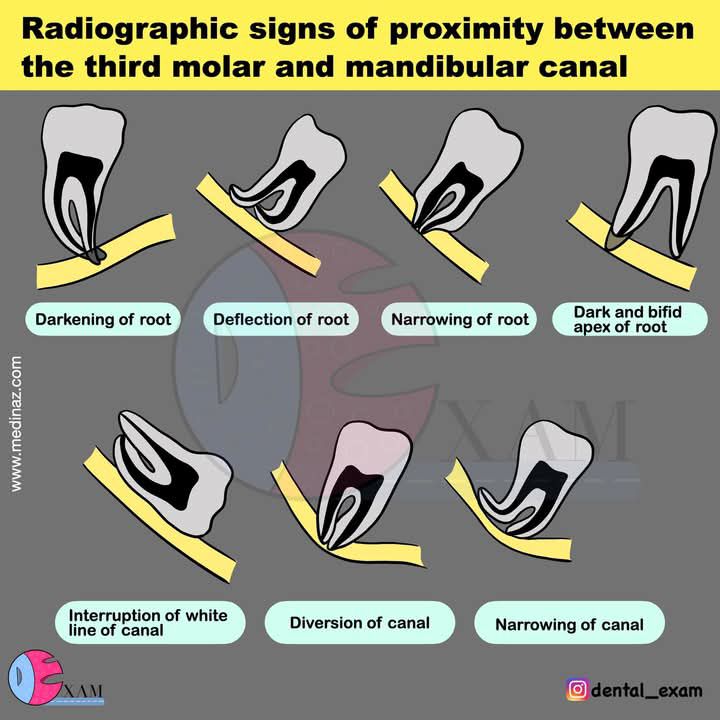 Ohee - Radiographic signs of proximity between the 3rd molar and ...