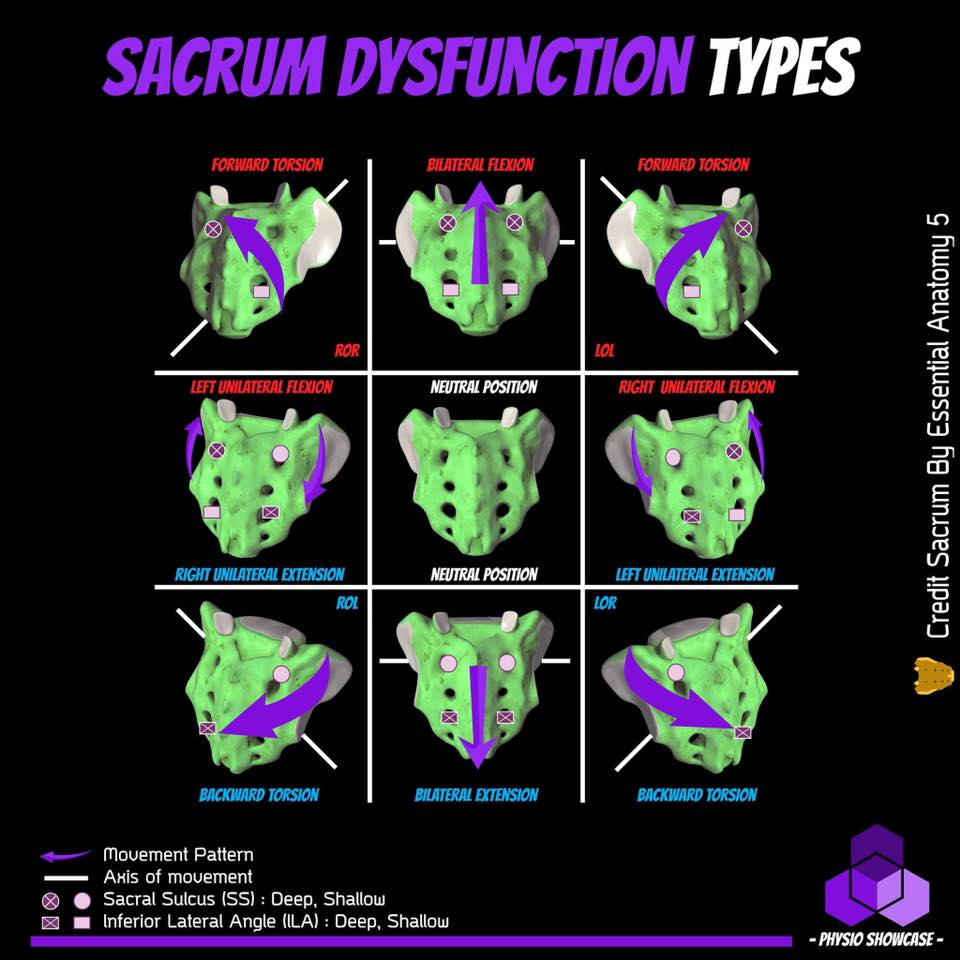 Physio Showcase - Sacrum Dysfunction Types 