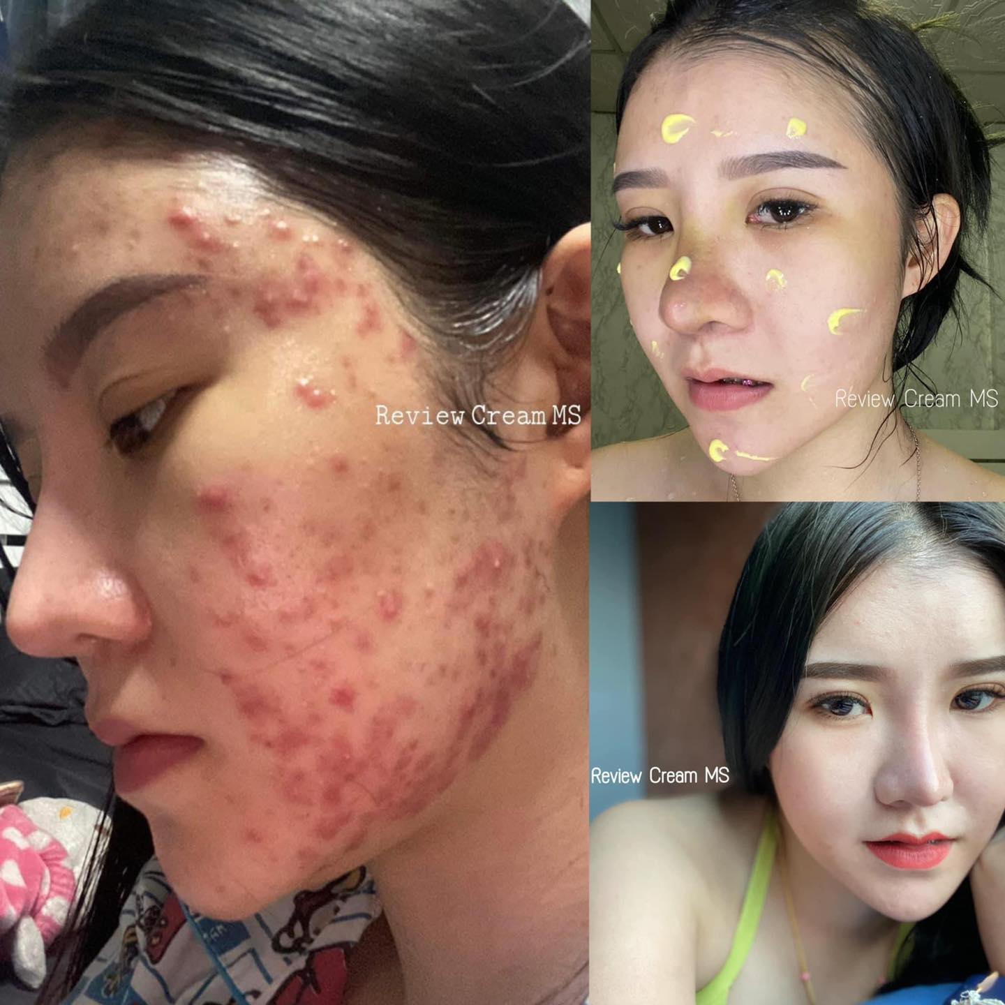 เป็นสิวซ้ำซากไม่หายสักที เปิดใจลอง~🫶🏻... - ครีมms mild skin | Facebook