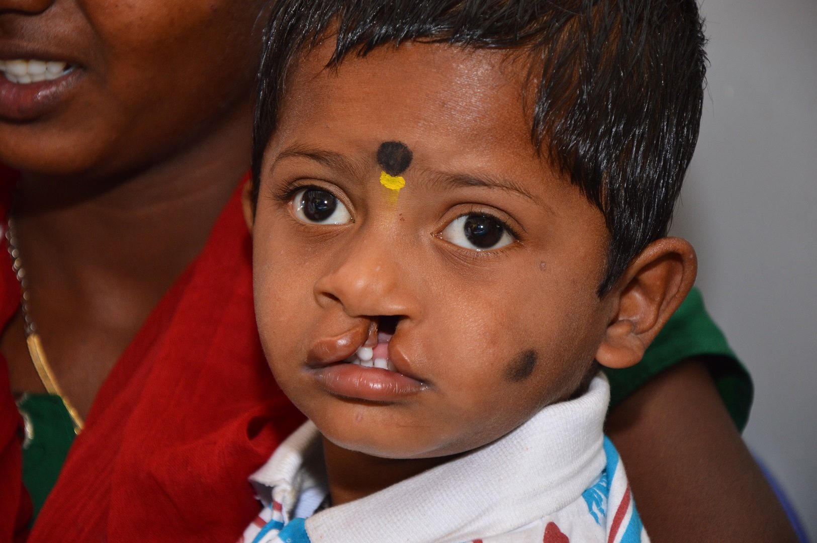 Facial Deformities - Child with Cleft Lip and Cleft Palate from ...