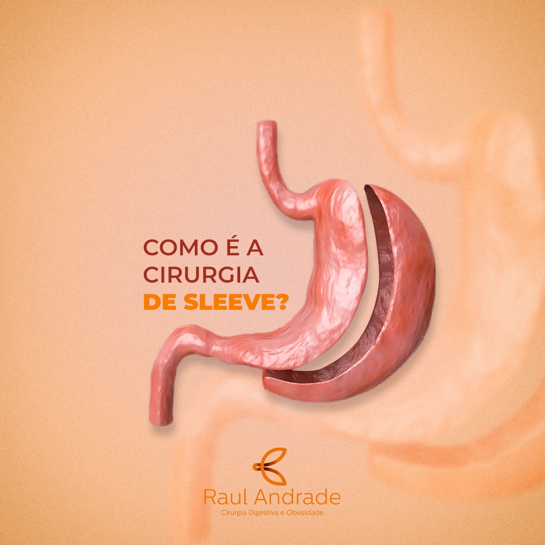 Raul Andrade A Gastrectomia Vertical a Sleeve é uma das...