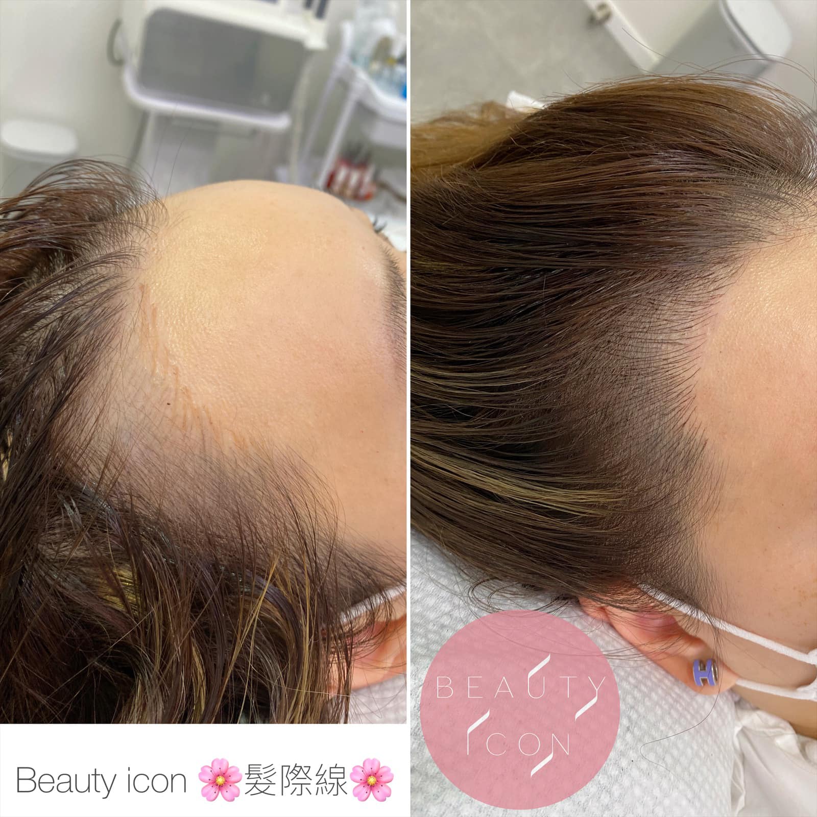 Beauty - Beauty icon韓國半永久化妝技術- 🌸髮際線🌸[填補修飾稀疏問題 ️]👍🏻 😗Beauty icon 仿真髮際線技術 ...