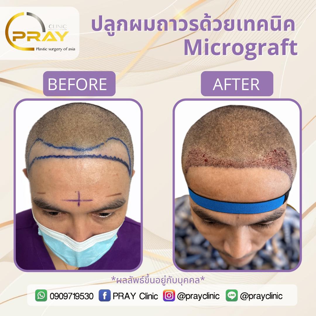 เทคนิคMicrograft จัดเต็มให้ทุกเคส... - PrayClinic เวชกรรม | Facebook