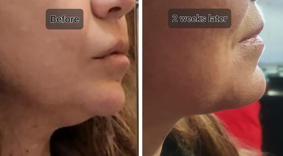 Fantastic results from just one... - Lambton Skin Clinic