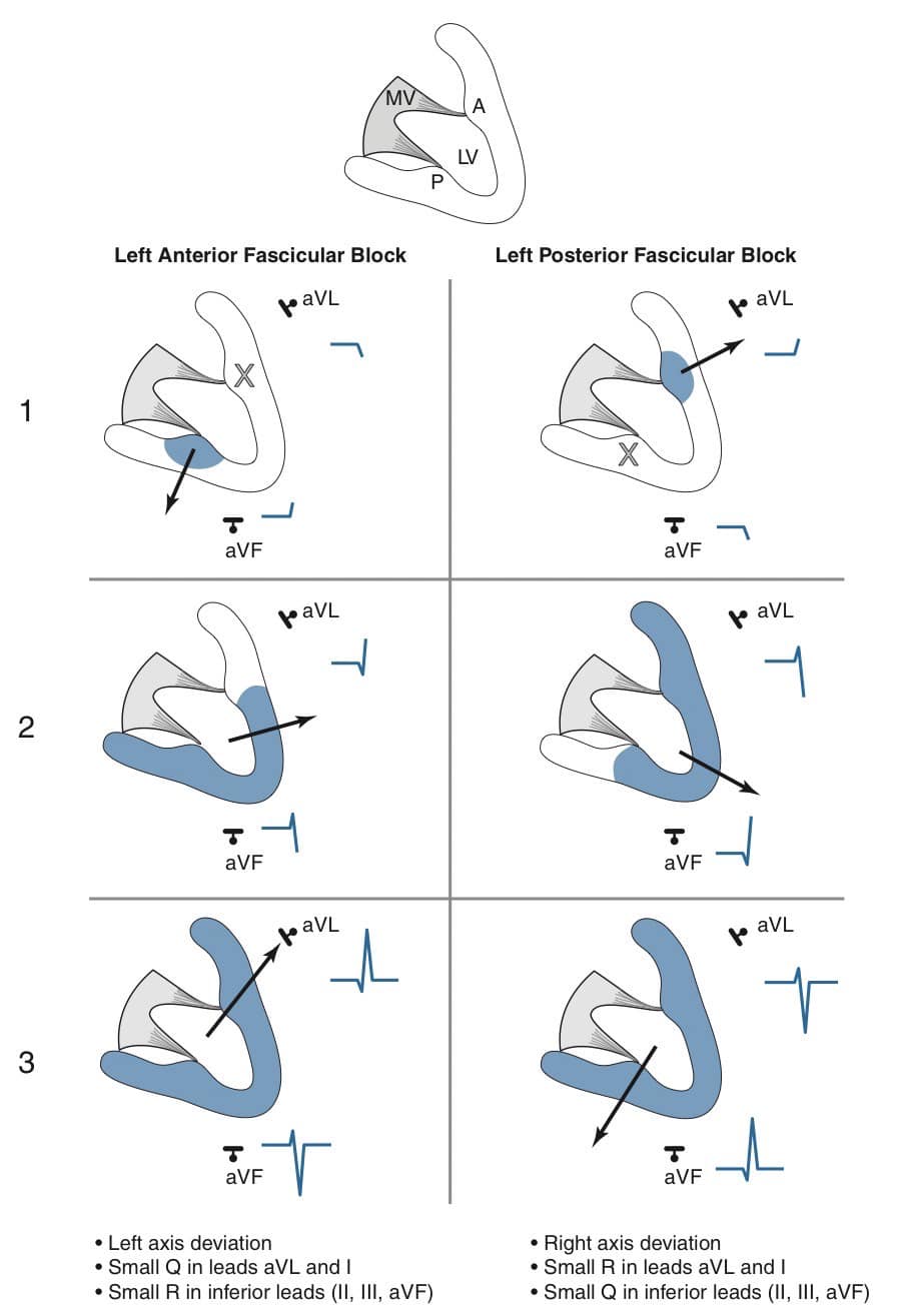 Secret - [Fascicular block ใน EKG เราจะพบ axis deviation อยู่แล้วไหม ...