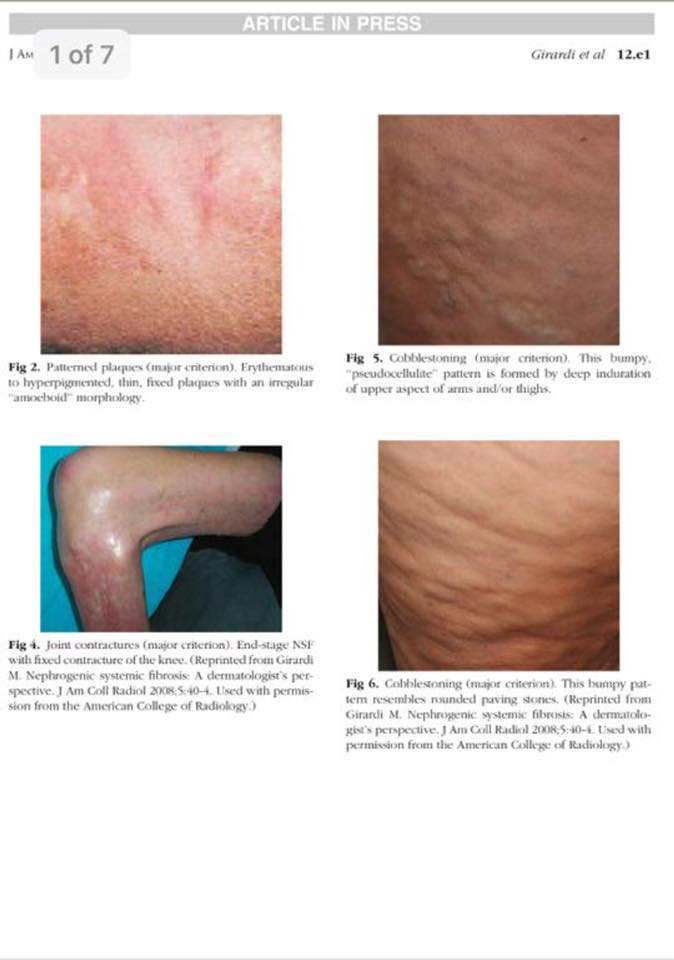 Gadolinium Toxicity / NSF - Some images of the progression