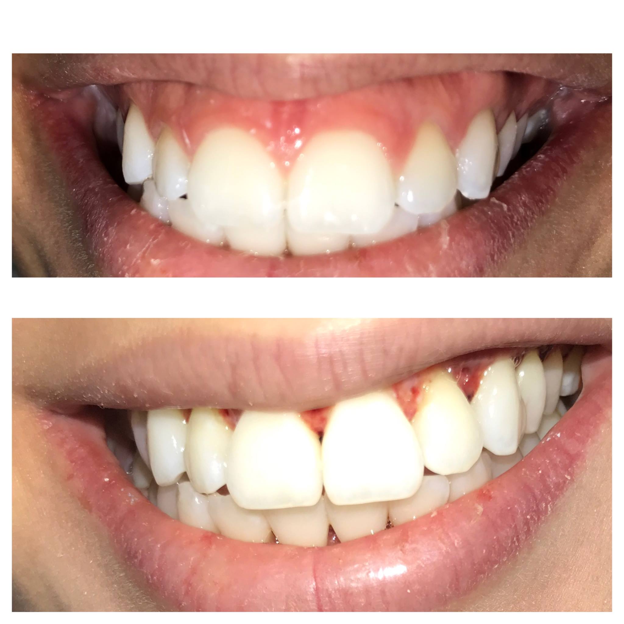 Dental - 📣 Reposição: Resina Applic Flow! Resina composta ﬂuida ...
