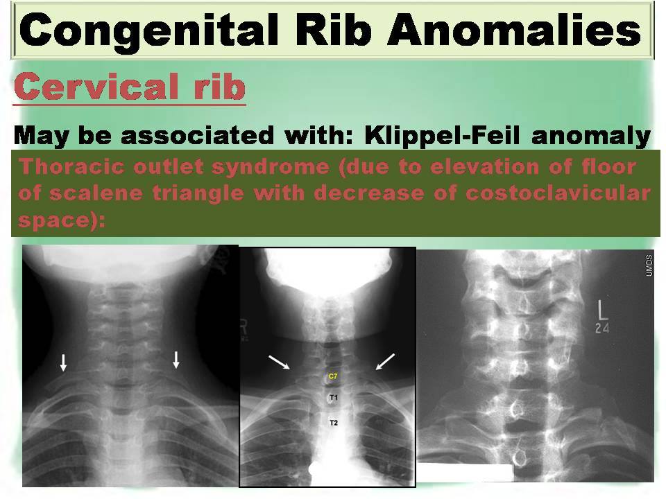CONGENITAL RIB ABNORMALITIES - Radiology Classroom