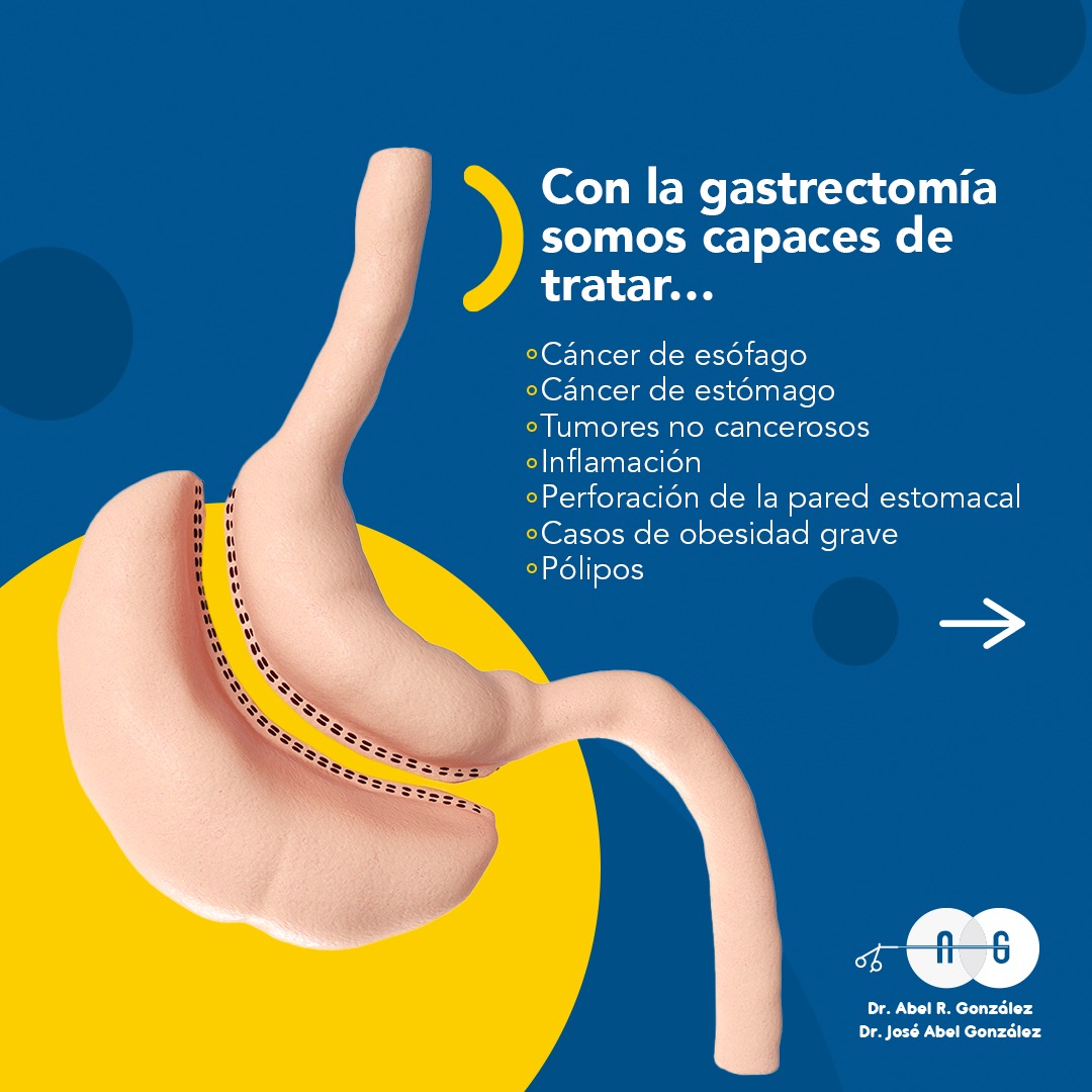 Cirugía - La nefrectomía es la extirpación parcial o completa del riñón ...