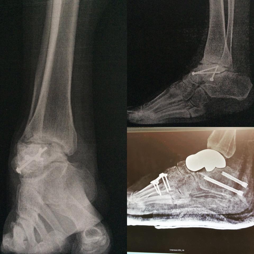 Before and... - American Orthopaedic Society of 3D Printing