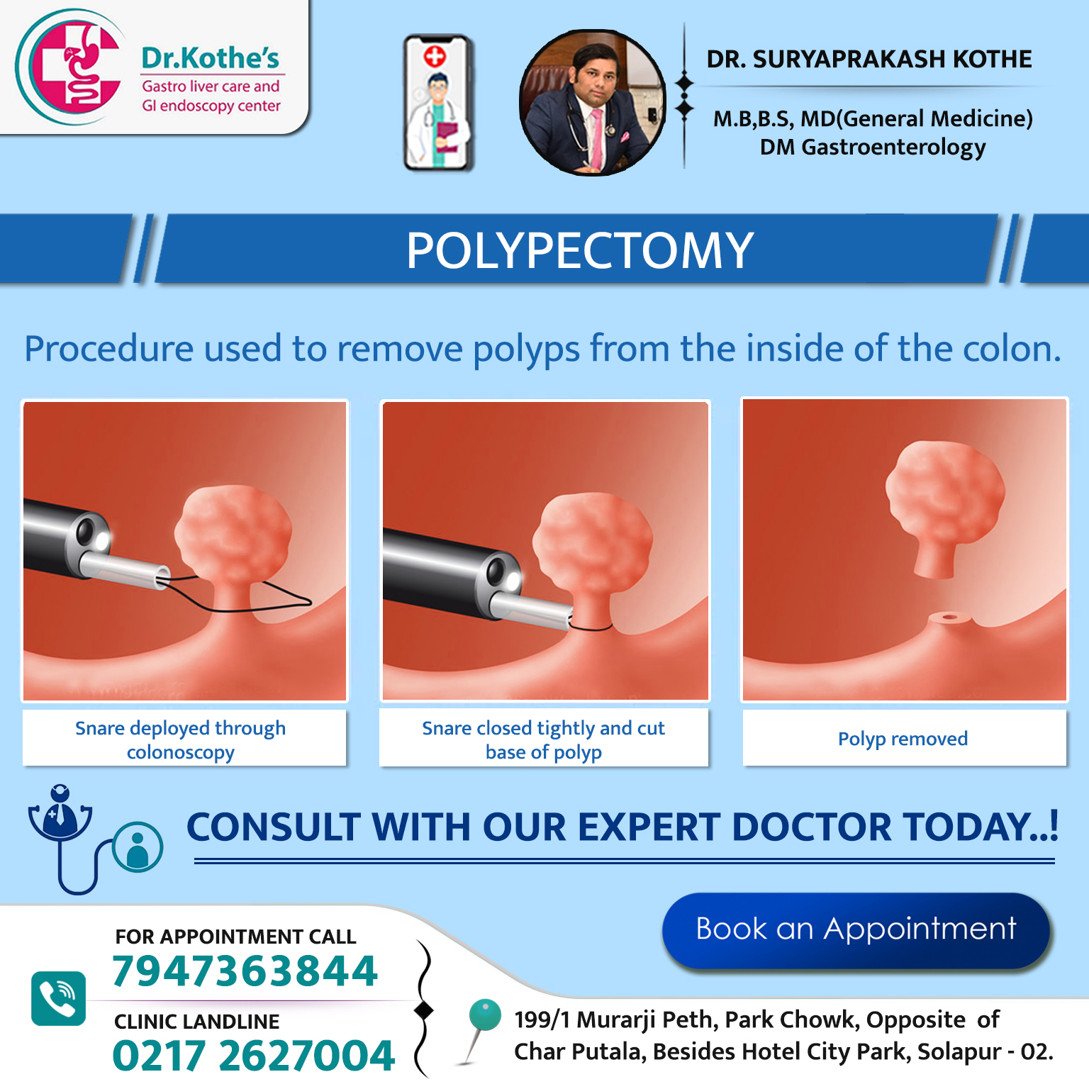 POLYPECTOMY: Procedure used to remove polyps from the inside of the ...