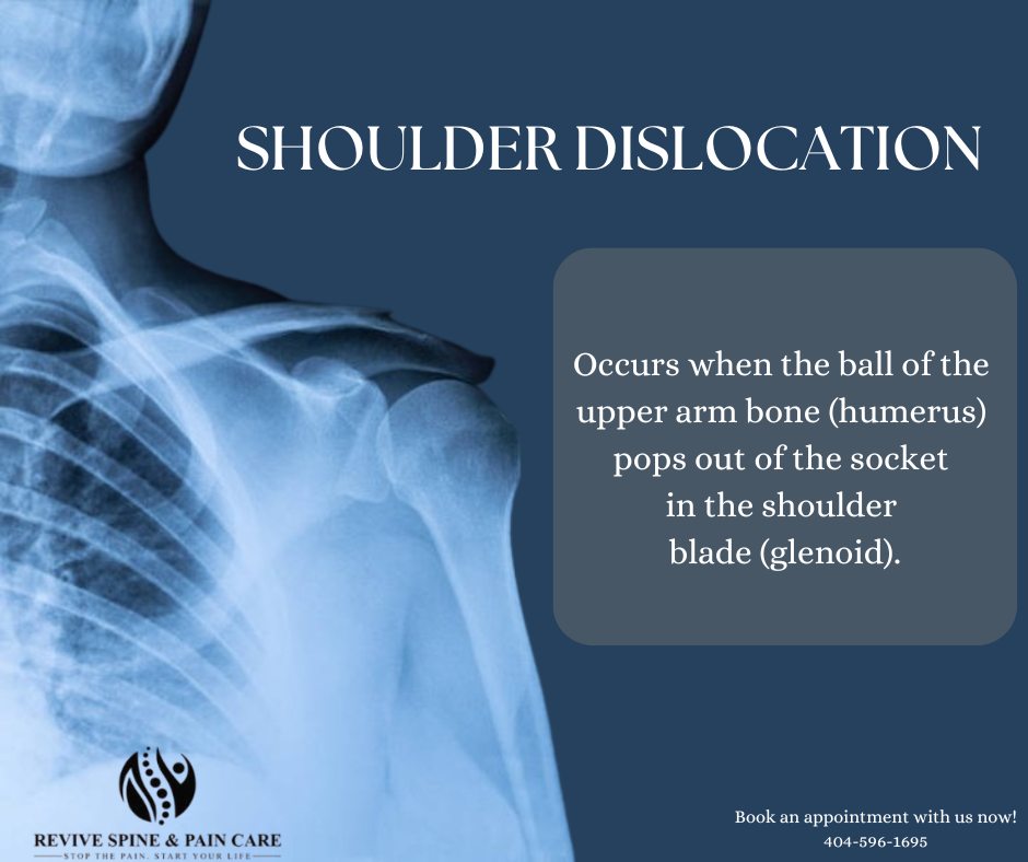 Revive - 🦴 A shoulder dislocation happens when the upper arm bone ...