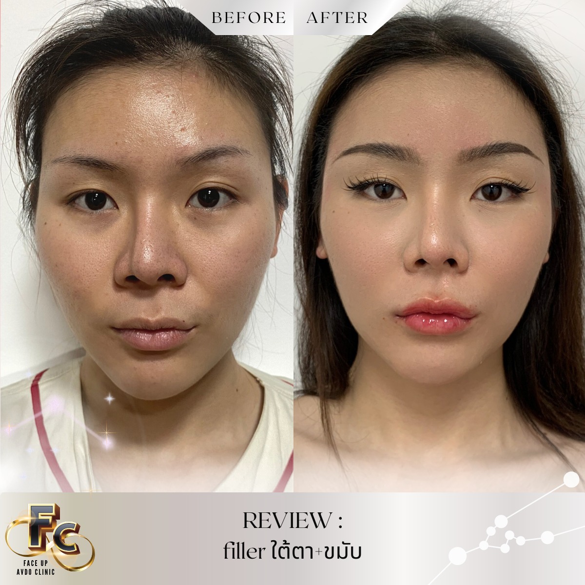 เติมเต็มใต้ตาและขมับ ... - Face Up AVDO Clinic | Facebook