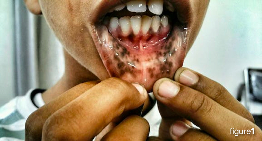 melanotic mucosa macule detected in the buccal of the patient who melanotic mucosa in the entire