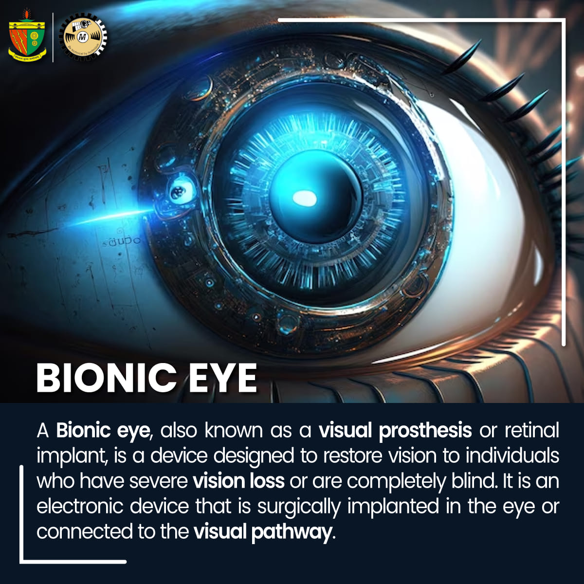 Model - #Visual_Prosthetics #Bionic_Eye The Bionic Eye also known as a ...