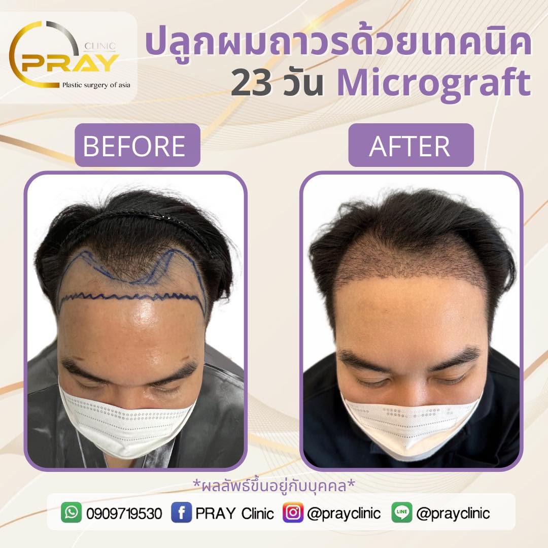 23 วันเทคนิคMicrograft... - PrayClinic เวชกรรม | Facebook
