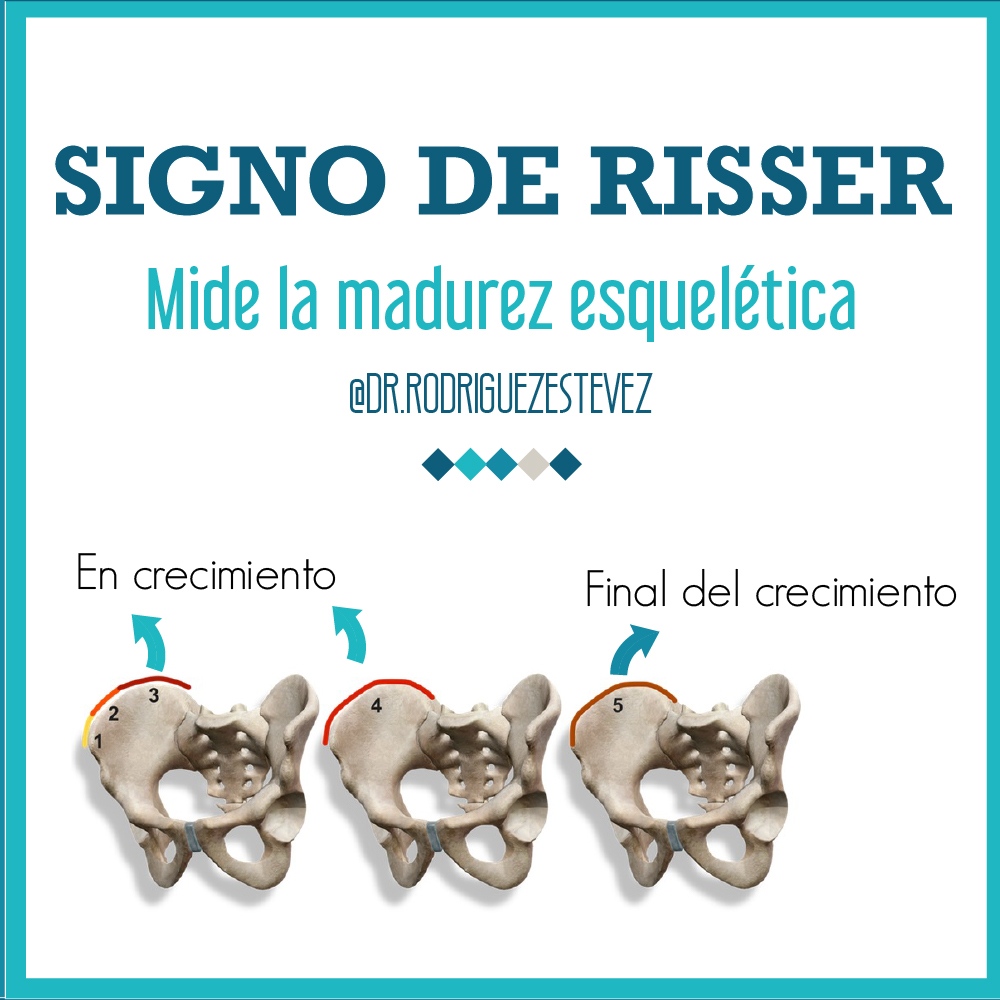 El signo de Risser es una... - Dr. Carlos Rodríguez Estévez | Facebook