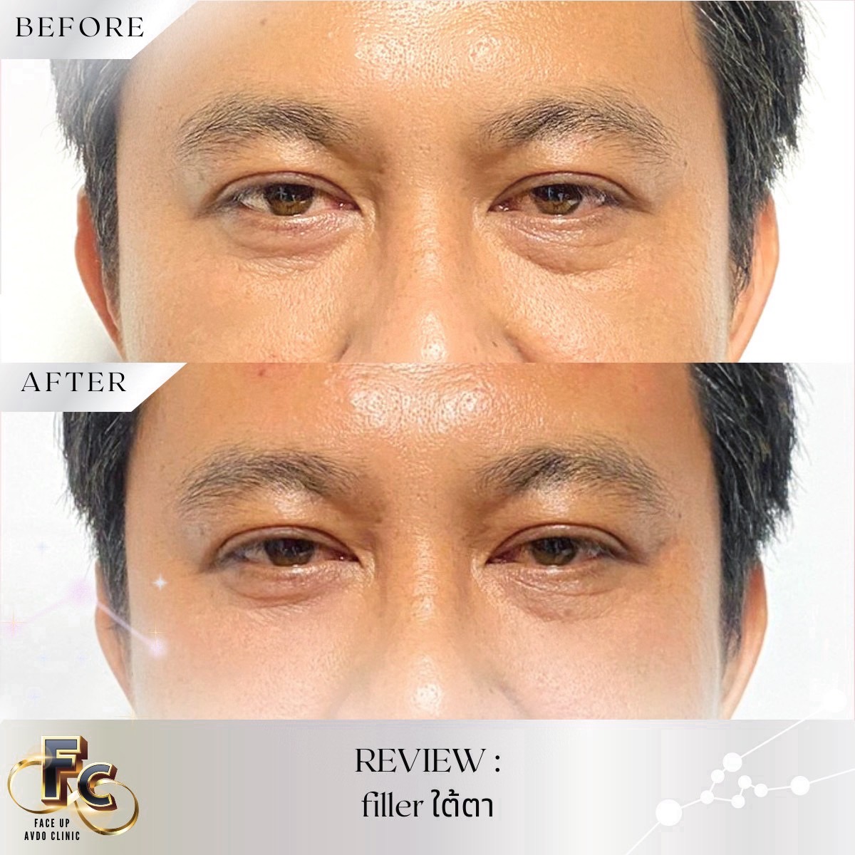 เติมเต็มร่องลึกใต้ตา เติมเต็มใต้ตา... - Face Up AVDO Clinic
