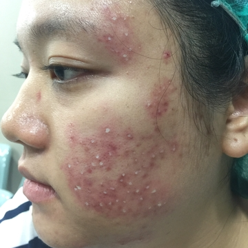 Side effects from the drug include headaches, nausea, vomiting and facial redness, while reports associated with the peptide have included increased moles and freckles, kidney dysfunction and swelling of the brain