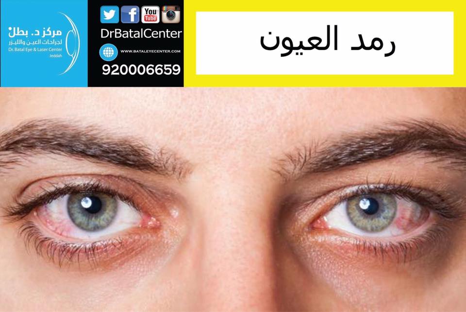 مُجمع بطل التخصصي - #رمد_العيون الأعراض - احمرار في عين واحدة أو كلتا ...