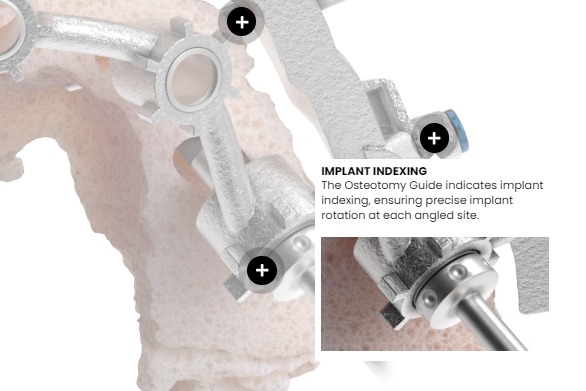 GuidedSmile - 🎯 Level up your implant precision! Our osteotomy guide ...