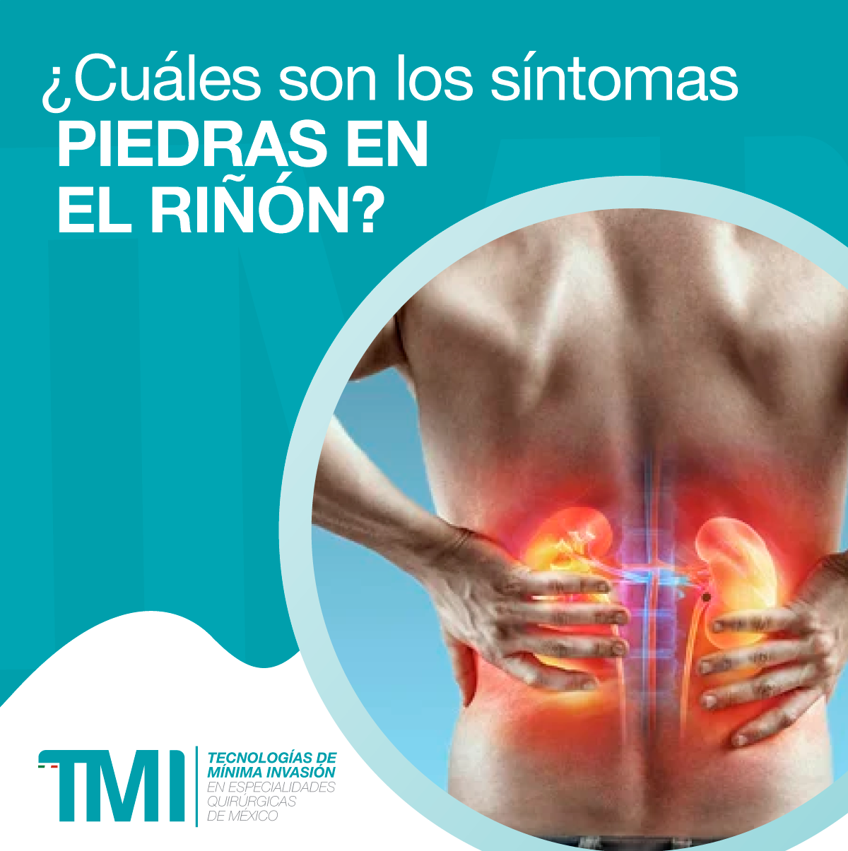 ¿Cuáles son los síntomas de piedras en el riñón? . -Náusea -Vómito ...