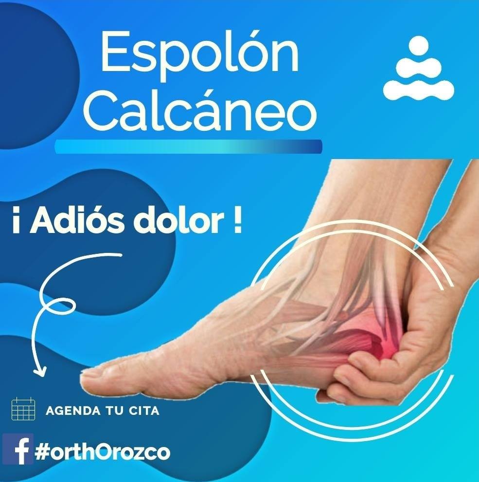 Fascitis Plantar: Lo Que Debes Saber Sobre El Mal Llamado Espolón ...