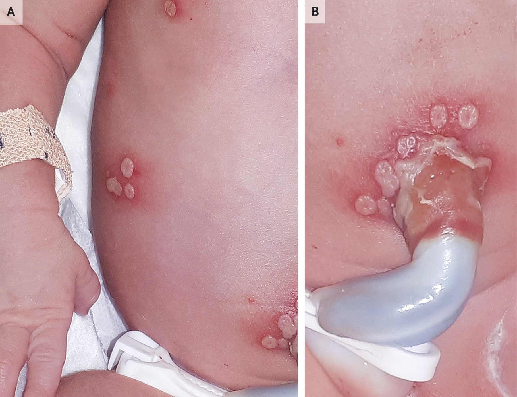 l-carnitine and genital herpes Neonatal HSV Infection in the ED ## Takeaways Although rare, neonatal simplex virus (HSV) infection causes devastating long-term sequelae significant mortality. Mortality can be as high as 85% if left GWYNNE BPC-157 Suplemento (que selank Flavor:Pineapple slush