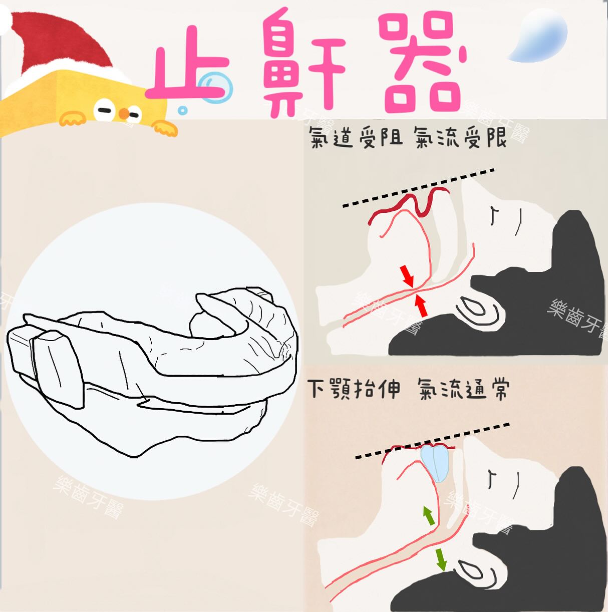 樂齒牙醫診所 - 什麼是止鼾器？—改善打鼾的簡單解方 打鼾（俗稱打呼）不僅影響睡眠品質，還可能是睡眠呼吸中止症的徵兆。對於輕中度的打鼾患者，止 ...