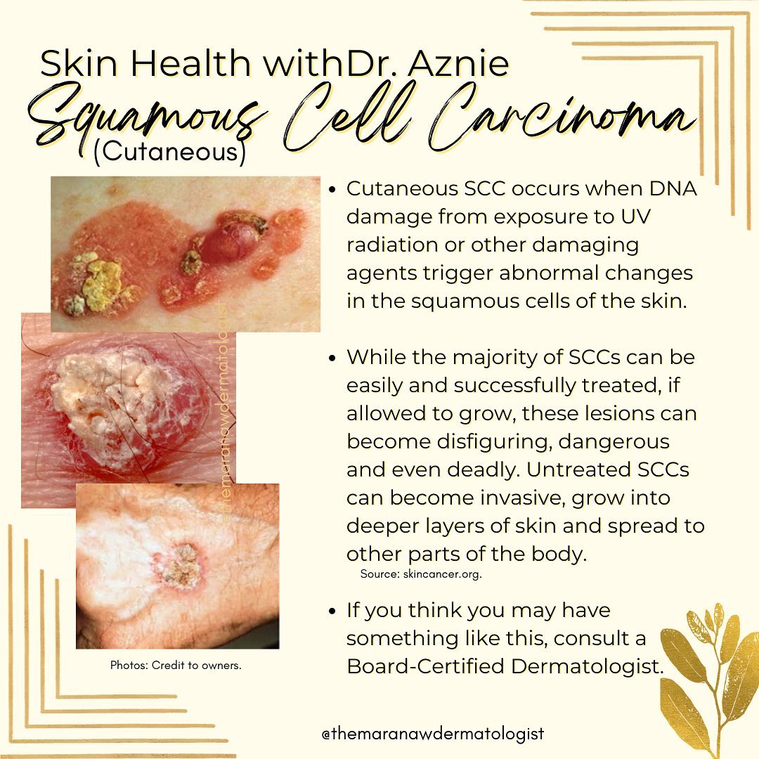 What is cutaneous SCC? Is... - Pandapatan Dermatology Clinic | Facebook