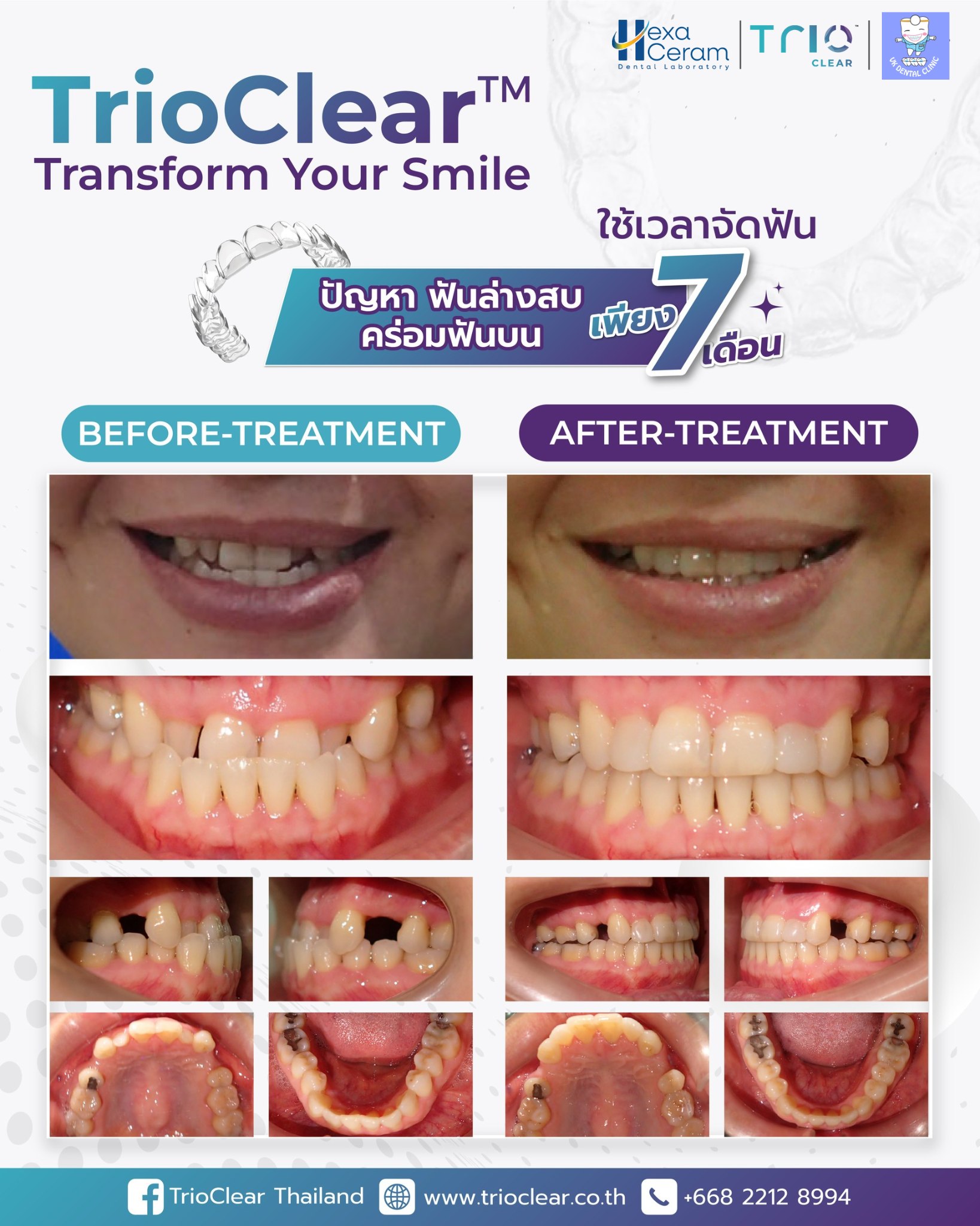 TrioClear - พลิกโฉมรอยยิ้มด้วย TrioClear ขอขอบคุณ คลินิก วิรัช-กอบกุล ...