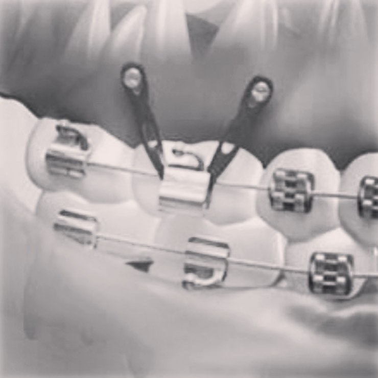 Condent - Los Orto implantes son un sistema de anclaje...
