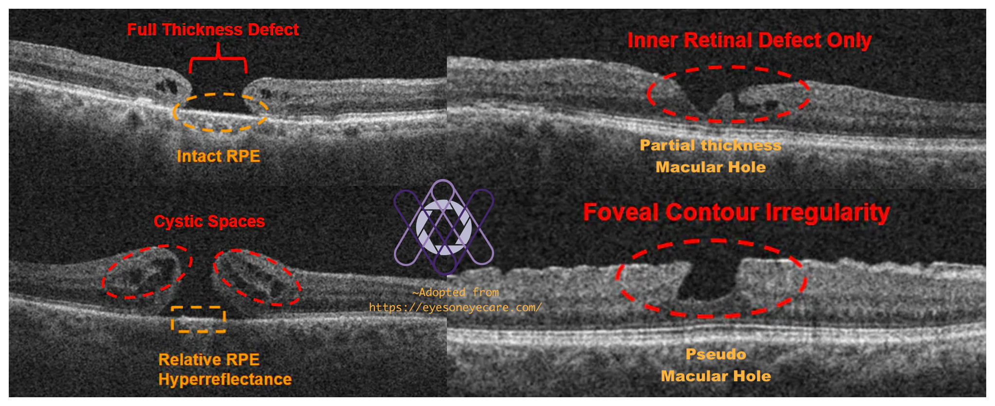 Differentiating Full thickness macular... - Acuity Eye Center | Facebook