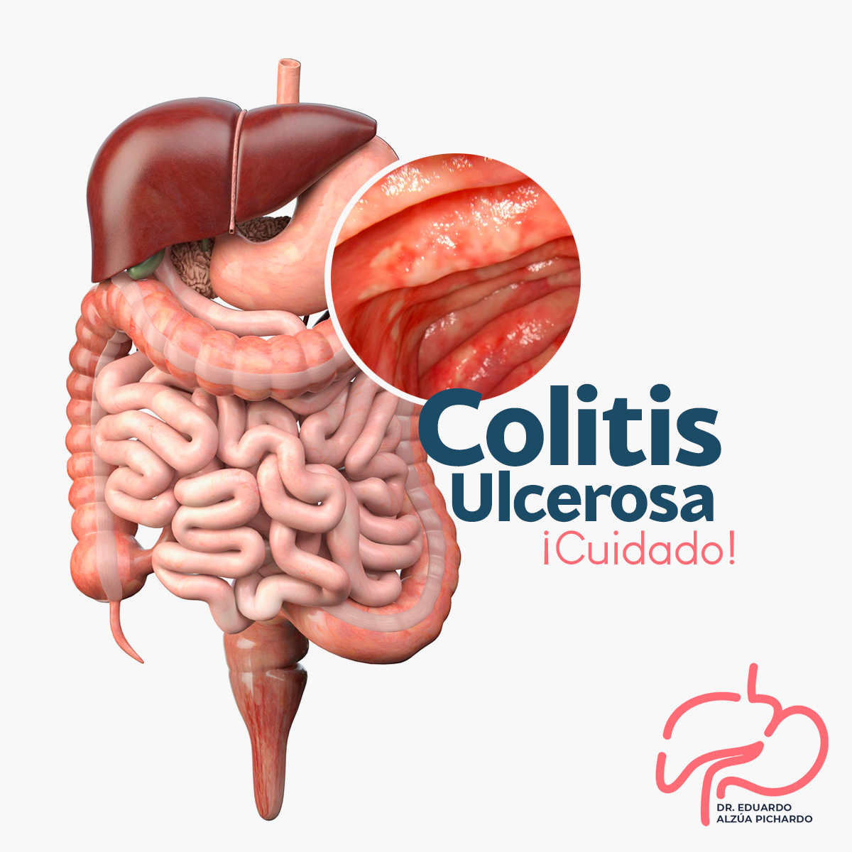 Dr. - La colitis ulcerosa es una enfermedad intestinal inflamatoria que ...