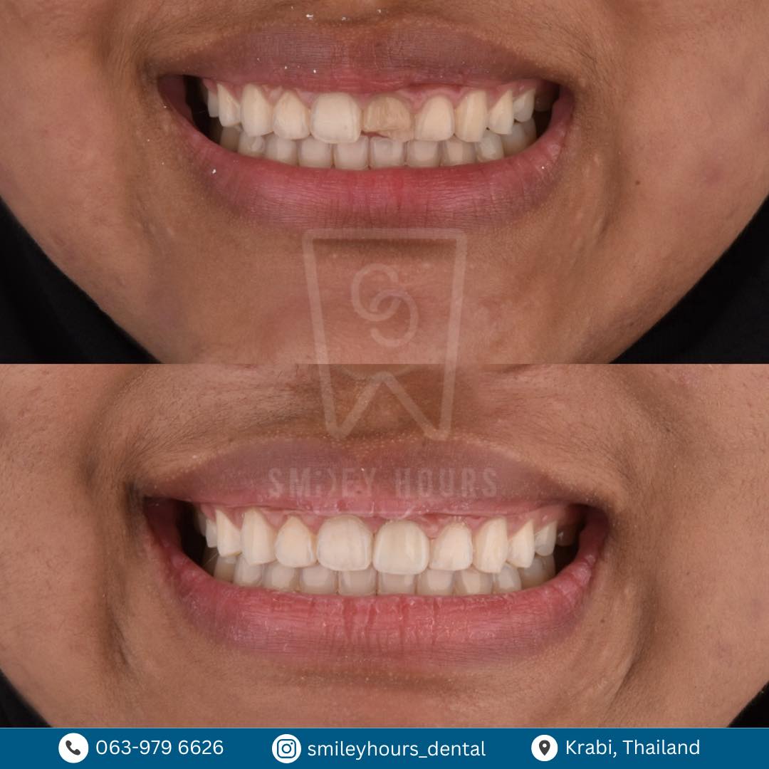 🧐ใครว่าวีเนียร์ ต้องทำยกแผง . 👉🏻เคสนี้ทำเซรามิกวีเนียร์เพียงซี่เดียว‼️ ...