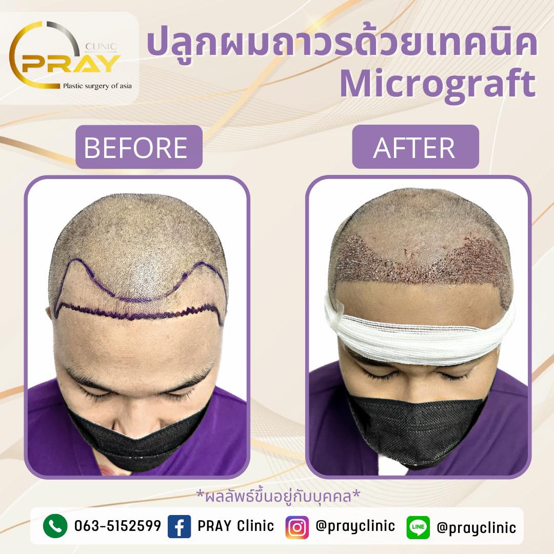 เทคนิคMicrograft จัดเต็มให้ทุกเคส... - PrayClinic เวชกรรม | Facebook