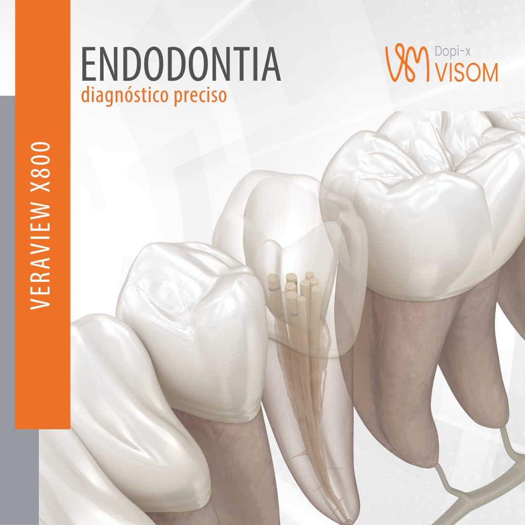 Dopi-x Visom - O sucesso de um tratamento endodôntico é...