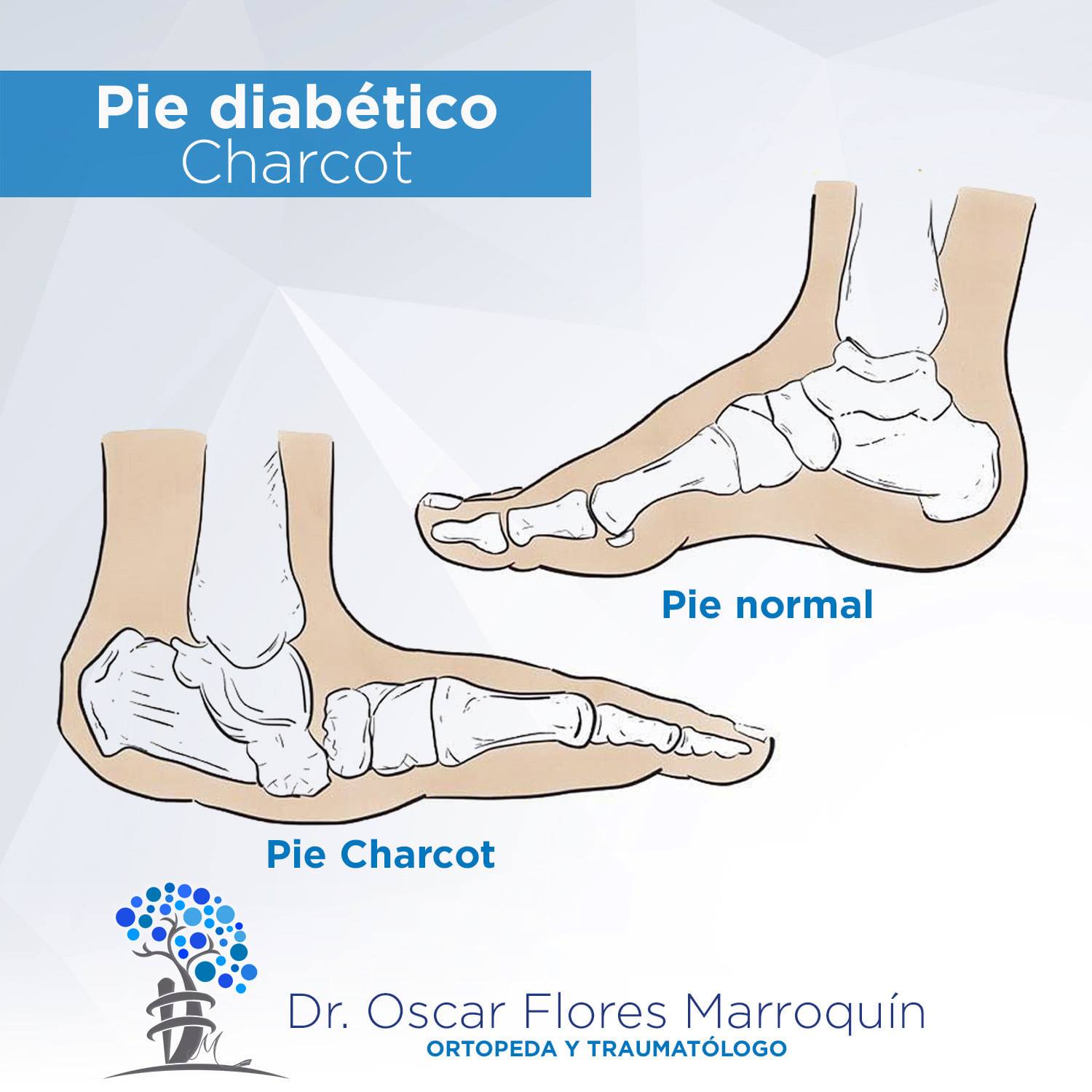Dr. Oscar Flores Marroquin - Ortopeda y Traumatólogo - Pie diabético