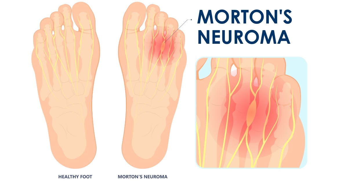 Mayfair - A Morton'sneuroma is a benign growth or tumor on the ...