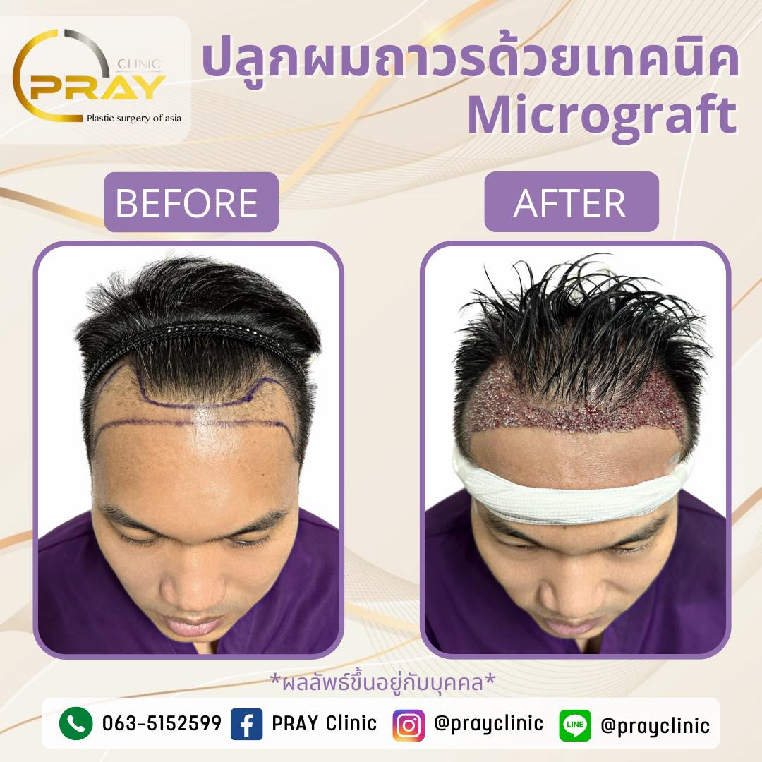 เทคนิคMicrograft จัดเต็มให้ทุกเคส... - PrayClinic เวชกรรม