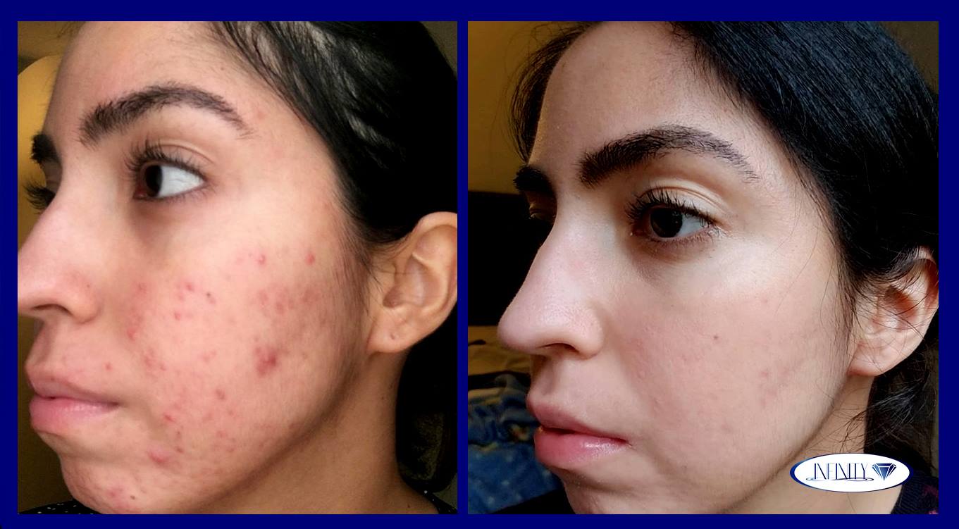 🔷Conoce crema natural... - Infinity / Tratamientos para acné