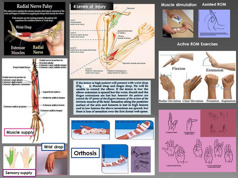 Physiotherapy Seva - Know More about Radial Nerve (Paralysis) Palsy ...