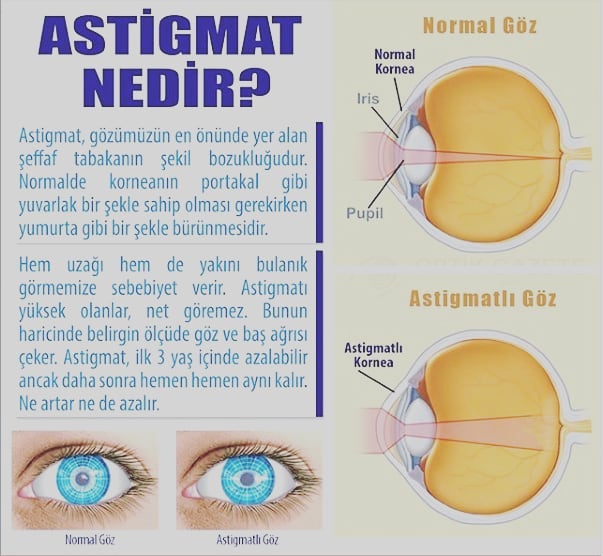 Astigmat Nedir Nedenleri Belirtileri Ve Tedavi Yontemleri Nelerdir Saglikli Yasam Gozler Genetik