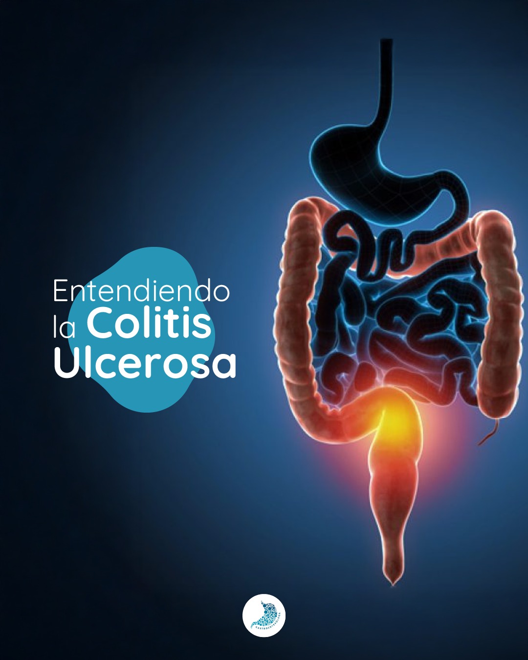Dra. - La colitis ulcerosa es una enfermedad inflamatoria crónica que ...