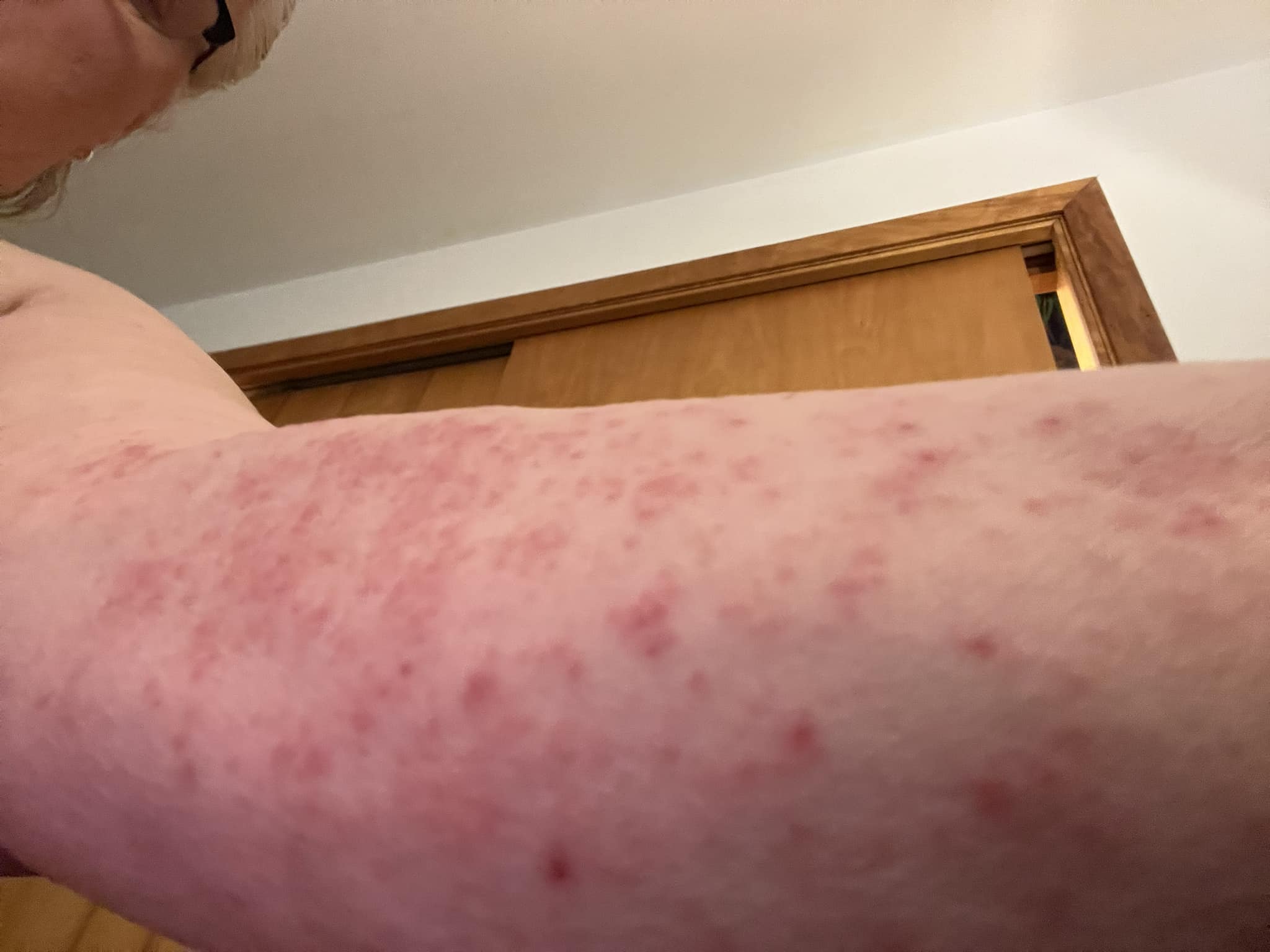 ishigaki glutathione rashes I need help, my Uncle has Parkinson's and Diabetes. He's started developing this rash at the beginning of the year and it's getting worse and doctors don't know what it is. Has Type:Glutathione Direct Film 3x bpc-157 muscle growth before Dermatology Tested