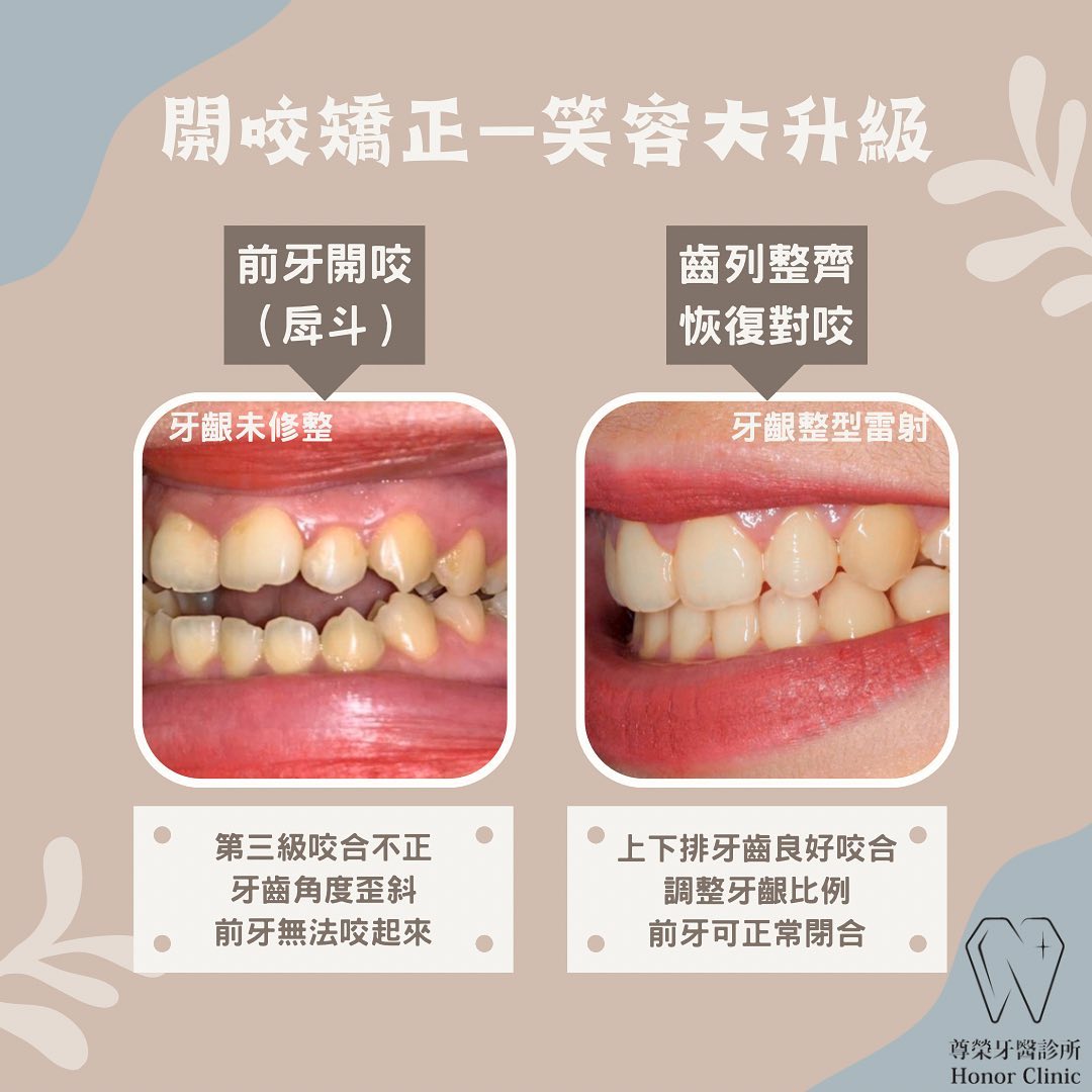 台北尊榮美學牙醫診所 - 【矯正知識】 關於開咬（open bite）常見的原因與問題 🔍 「開咬」是指什麼？... | Facebook