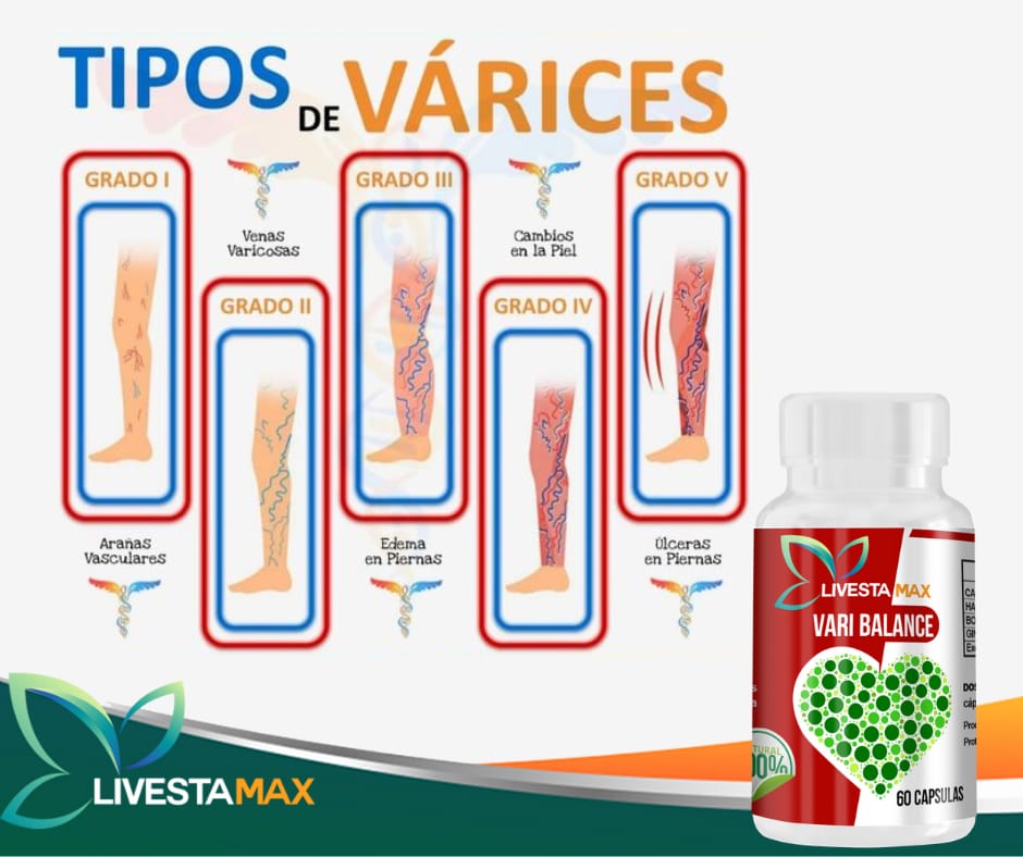 Suplementos - 😲SABES QUE TIPOS DE VARICES EXISTEN 🫴🏻 Las várices son ...