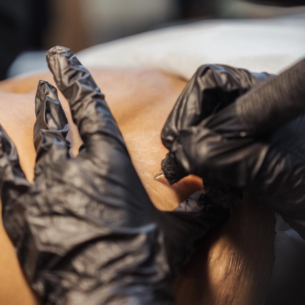 Dermal Camouflage Clinic | Brisbane QLD