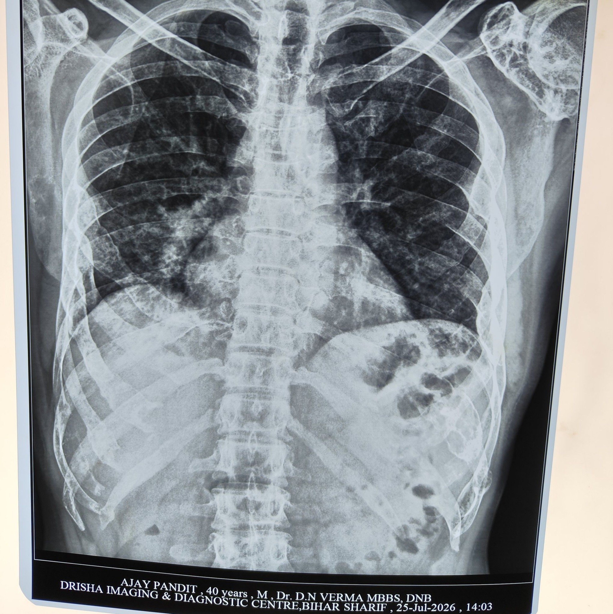 20-year-female-with-left-long-time-h-o-radiology-esmile-facebook